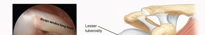 Relieve Shoulder Pain: Arthroscopic Treatment of Biceps Tendinopathy