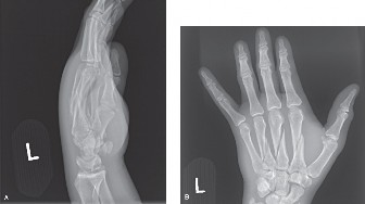 Open Reduction for Multiple Metacarpal Fractures: Case Review