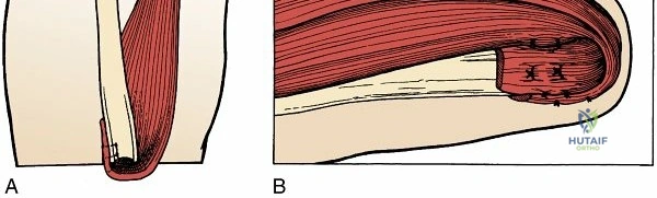 Illustration of arthritides arthritides arthritides - Dr. Mohammed Hutaif
