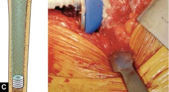 توضيح طبي: استبدال مفصل الورك الكلي بتقنية الإسمنت للفخذ: دليلك الشامل لنتائج تدوم طويلاً مع الأستاذ الدكتور محمد هطيف في صنعاء