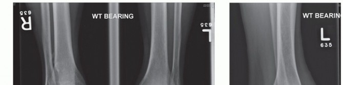 Considering Scandinavian Total Ankle? Discover If It's For You