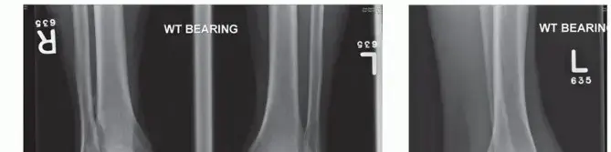 استبدال مفصل الكاحل الكلي: دليل شامل لمرضى الكاحل في اليمن والخليج العربي