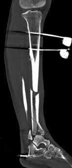 Illustration 6 for Complex Tibial Shaft Fracture: Plate Fixation for Plafond Extension
