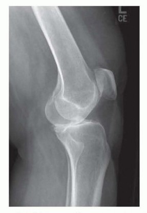 Illustration 3 for Unicondylar Knee Arthroplasty: Is This Your Solution to Knee Pain?