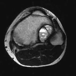 صورة توضيحية لـ كيس العظم المتمدد: دليل شامل للمرضى مع الأستاذ الدكتور محمد هطيف في صنعاء