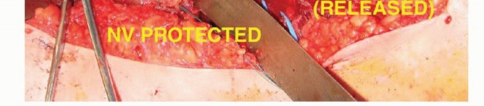 صورة طبية: استئصال أورام الكتف مع الحفاظ على الطرف: أحدث التقنيات لنتائج مثالية مع الأستاذ الدكتور محمد هطيف