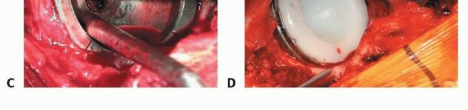 Illustration 11 for Uncemented THA: Critical Soft Tissue Tension for Joint Stability