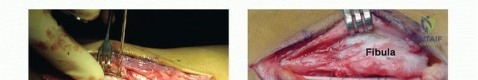 Lateral Popliteal Nerve Block: A Comprehensive Surgical Guide