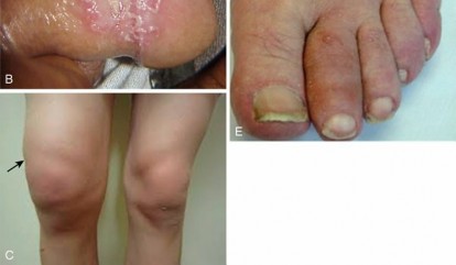 Illustration of crystal deposition arthropathy - Dr. Mohammed Hutaif