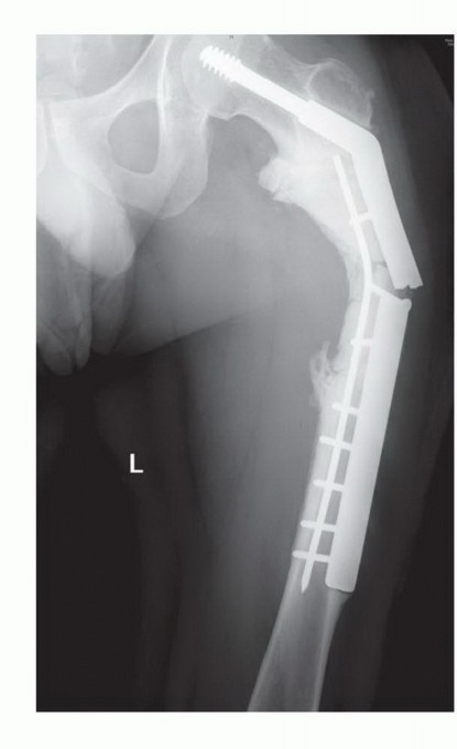 Illustration 27 for Plain Radiograph Showing MBD: Surgical Planning to Prevent Failures