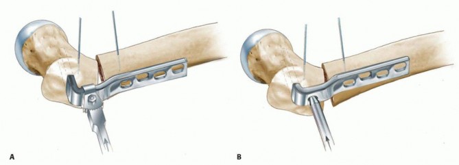 Illustration 14 for Proximal Femoral Osteotomy: When This Hip-Saving Surgery Is Performed