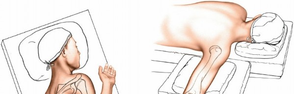 Optimal Humerus Posterior Approach: Maximize Access & Nerve Safety