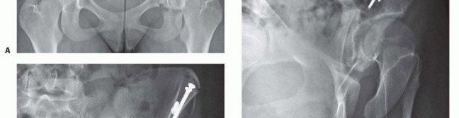 Illustration 26 for Restore Hip Health: Pelvic Osteotomy for Acetabular Dysplasia & CEA of Less