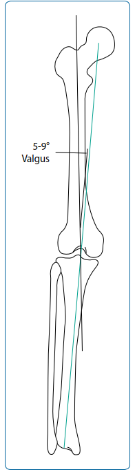 Illustration 1 for Unlock Knee Alignment: Your Guide to Distal Femoral Osteotomy