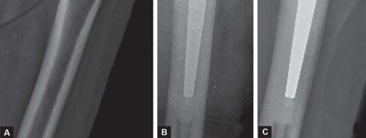 توضيح طبي: استبدال مفصل الورك الكلي بتقنية الإسمنت للفخذ: دليلك الشامل لنتائج تدوم طويلاً مع الأستاذ الدكتور محمد هطيف في صنعاء
