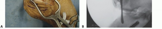 Illustration 16 for Lateral Ankle Repair: Maximize Stability with Interference Screw Fixation