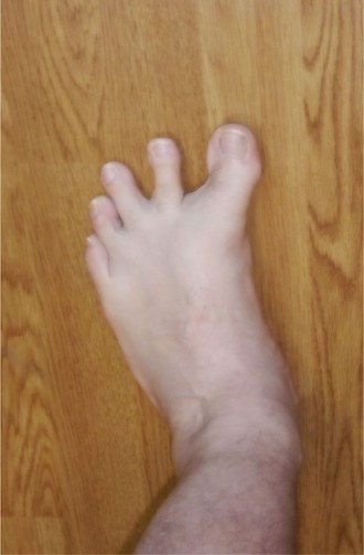 Understanding Hallux Varus: The Lateral Capsule's Lateral Support