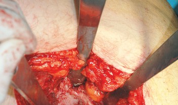 Illustration 38 for Unlock the Figure Posterior Approach to the Hip