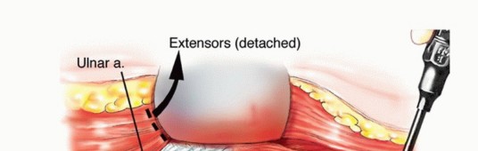 صورة طبية: استئصال الجزء البعيد من عظم العضد: تقنيات آمنة للحفاظ على الطرف في صنعاء مع الأستاذ الدكتور محمد هطيف