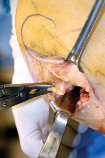 Illustration 25 for Unicompartmental Knee Arthroplasty: Master decisions with this b c figure guide.