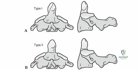 Illustration of odontoid process dens - Dr. Mohammed Hutaif
