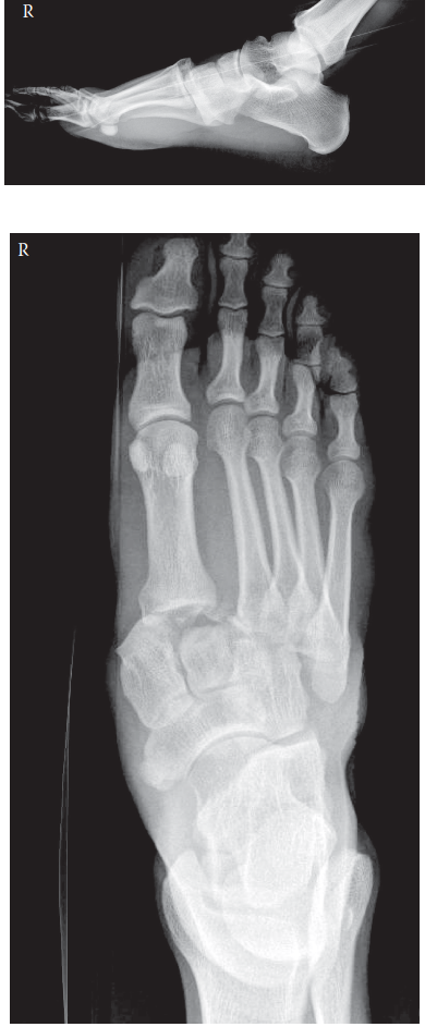 Decode a Lisfranc Injury Case: Diagnosis & Clinical Pearls