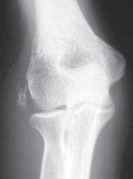 Unlock Relief: Arthroscopic Treatment of Epicondylitis Explained