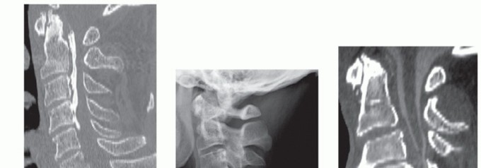 Stop Numbness & Instability: Corpectomy and Fusion Guide