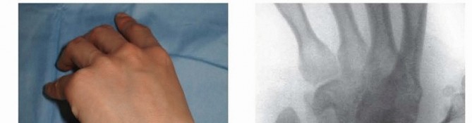 Mastering Percutaneous Fixation of Acute Scaphoid Fractures