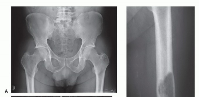 Illustration 11 for Plain Radiograph Showing MBD: Surgical Planning to Prevent Failures