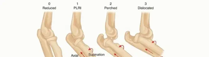 خلع الكوع البسيط: دليل شامل للمرضى نحو التعافي الكامل مع الأستاذ الدكتور محمد هطيف