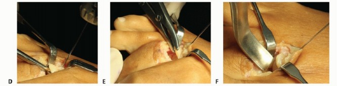 Illustration 34 for Plantar Plate Repair: End Lesser Toe Pain & Instability