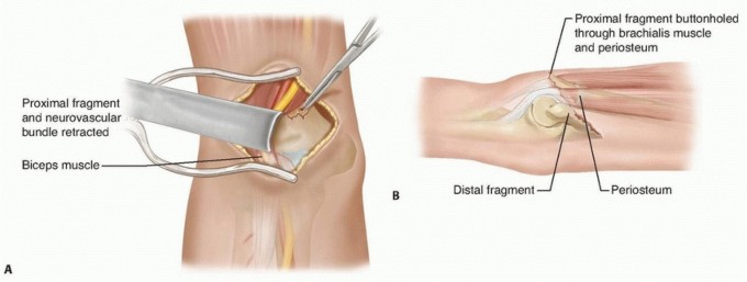 Illustration of treated with open - Dr. Mohammed Hutaif