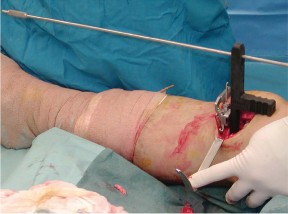 Illustration 61 for Knee Arthroplasty: Avoiding Pitfalls & Benefiting from UKA