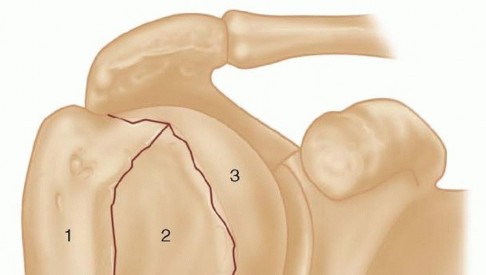 Hemiarthroplasty for Proximal Humerus: What You Need to Know