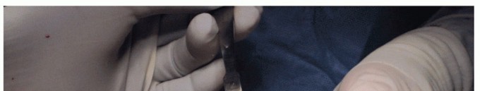 Illustration 27 for End Articular Cartilage Loss: Arthrosurface HemiCAP Resurfacing