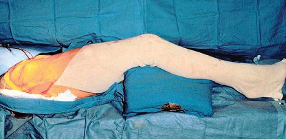 Illustration 21 for Bernese PAO: Unlocking the Procedure with Level V Evidence Insights