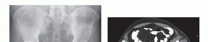 توضيح طبي: جراحة نقائل الحوض: حل شامل لآلام العظام واستعادة الحركة مع الأستاذ الدكتور محمد هطيف