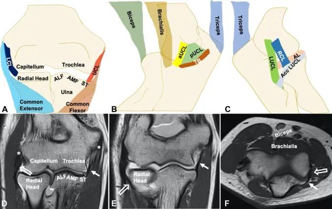 Triad of the Elbow: Master Diagnosis & Treatment with Our Guide