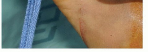 صورة طبية: تجنب الجراحة الكبرى: علاج أورام العظام بالنيتروجين السائل بتقنية الصب المباشر