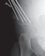 Illustration 64 for Bernese PAO: Unlocking the Procedure with Level V Evidence Insights