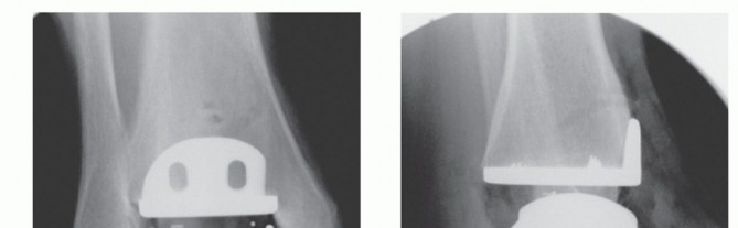 Illustration 28 for HINTEGRA Total Ankle: Unlocking Natural Ankle Movement