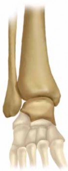 Optimal Fixation of the Ankle: Open Reduction & Internal Fixation