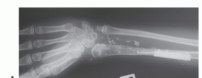 صورة طبية: ترقيع الشظية الوعائي الحر: حلول متقدمة لعيوب العظام المعقدة