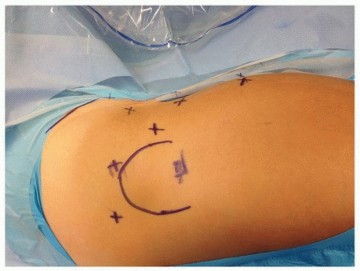 Illustration of arthroscopy for nonstructural - Dr. Mohammed Hutaif