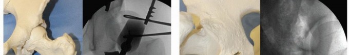 Illustration 12 for Periacetabular Osteotomy: Realigning your hip via the superior pubic ramus