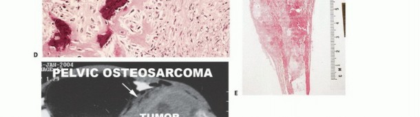 Illustration of benign bone tumors - Dr. Mohammed Hutaif