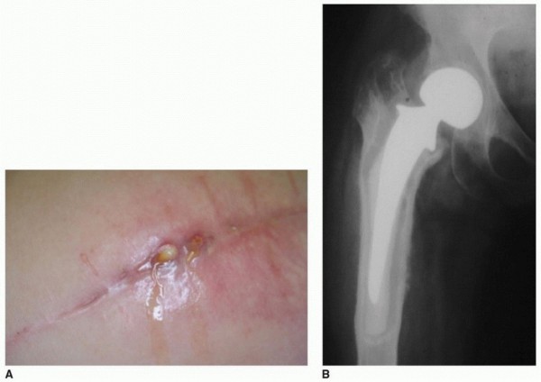 PJI of the Hip: Two-Stage Revision: When & How to Prepare