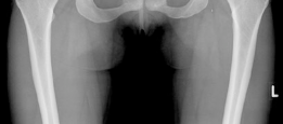 Illustration 2 for Bernese Periacetabular Osteotomy: Your Definitive Case Title Bernese