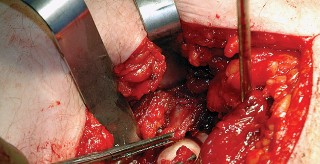 Illustration 64 for Unlock the Figure Posterior Approach to the Hip